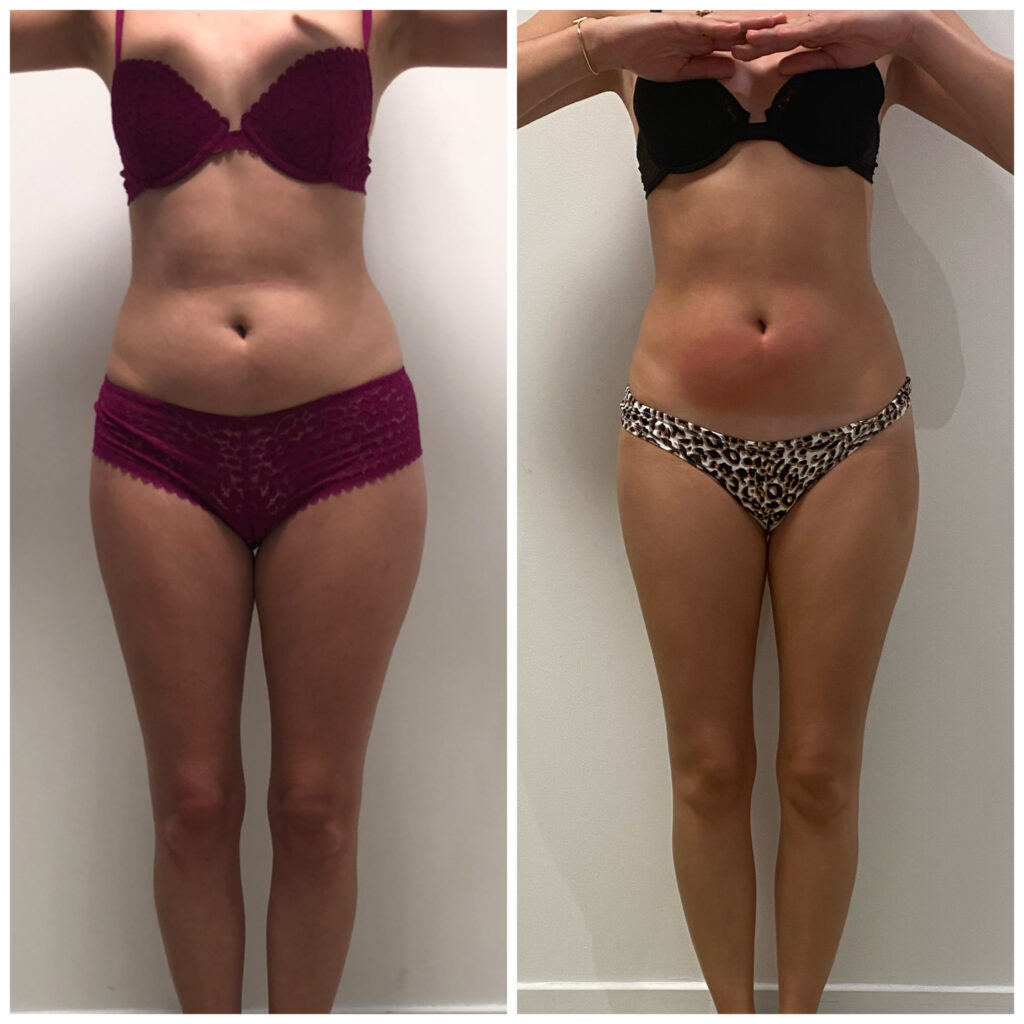 Cryo-avant-apres-resultat