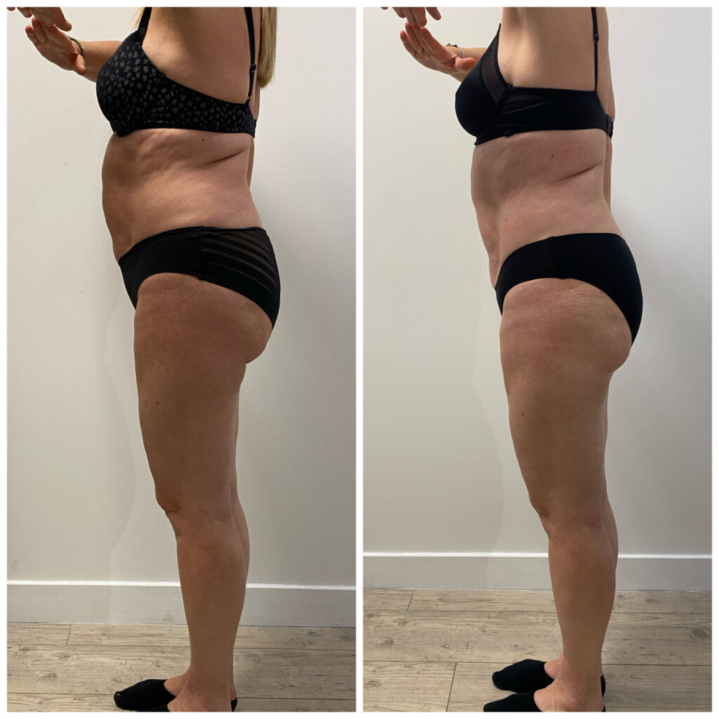 avant-apres-resultat-cryo-femme
