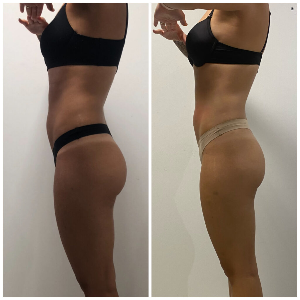 chryolipolyse-resultat-avant-apres-linstant-cryo