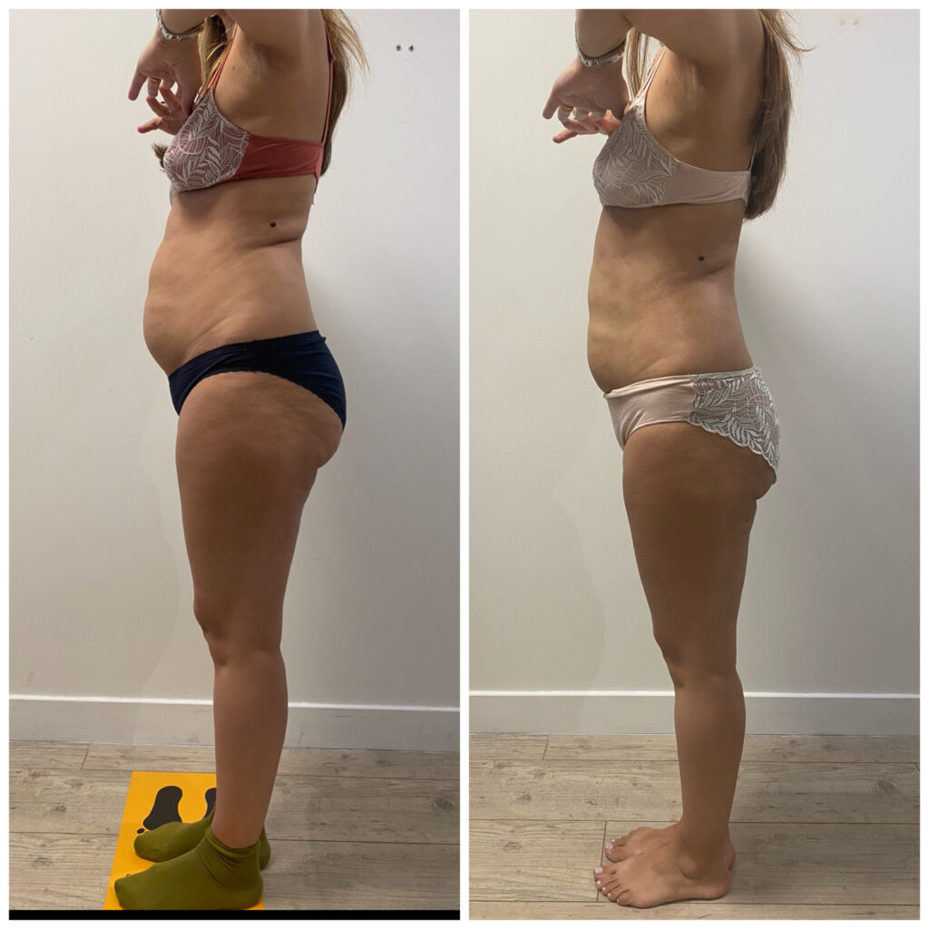 resultat-avant-apres-cryo