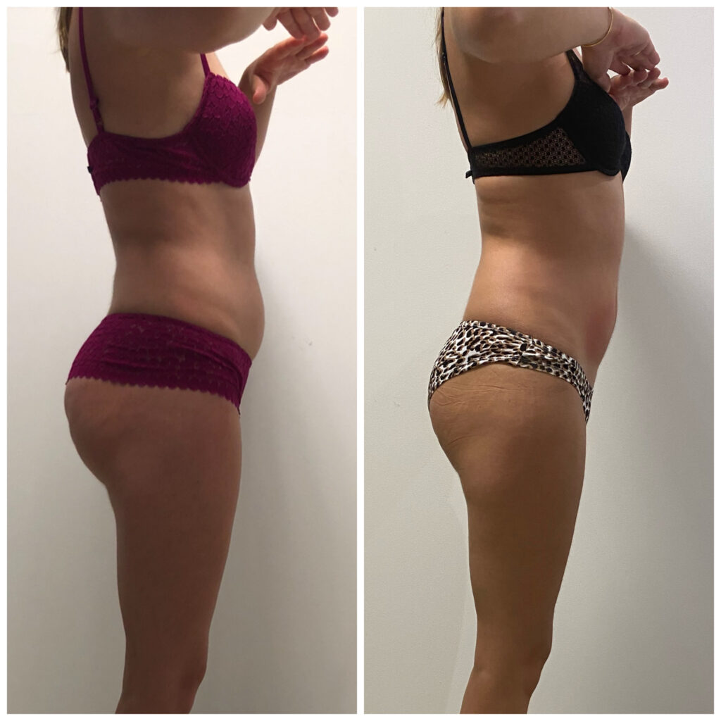 resultat-femme-avant-apres-cryo