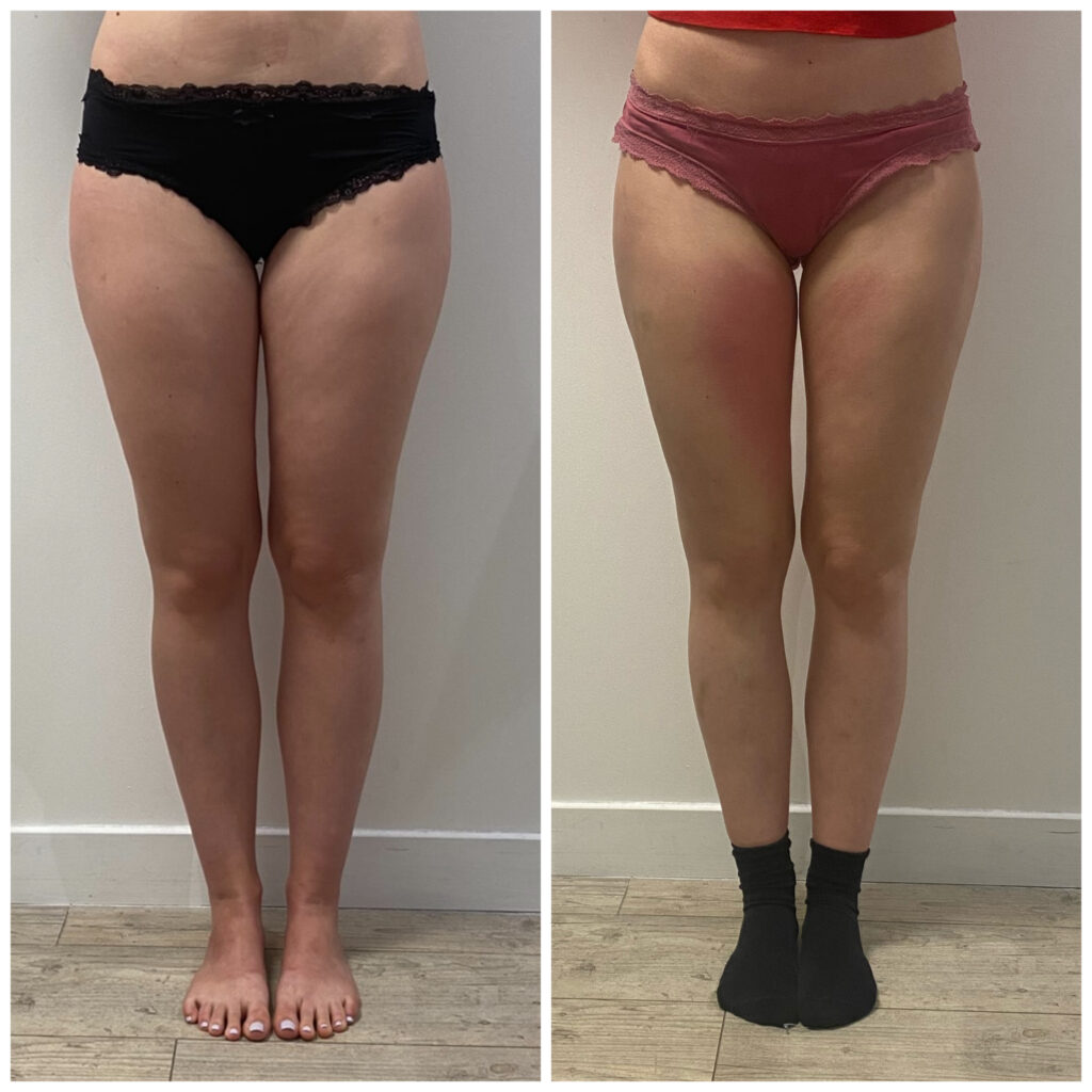 resultat-linstant-cryo-avant-apres