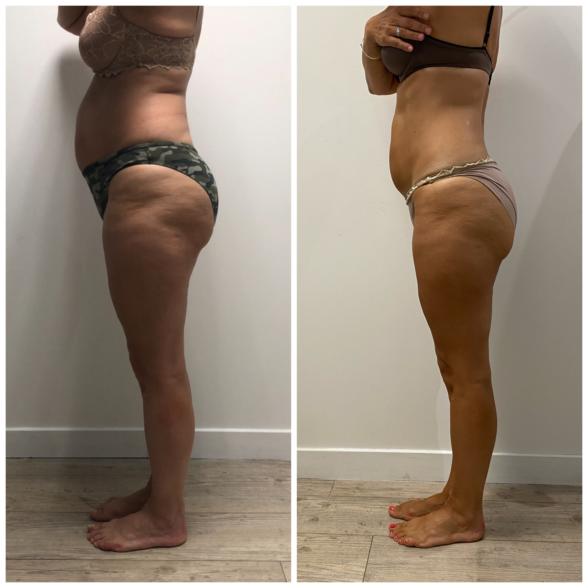 seance-abdomen-cryo-avant-apres-16cm